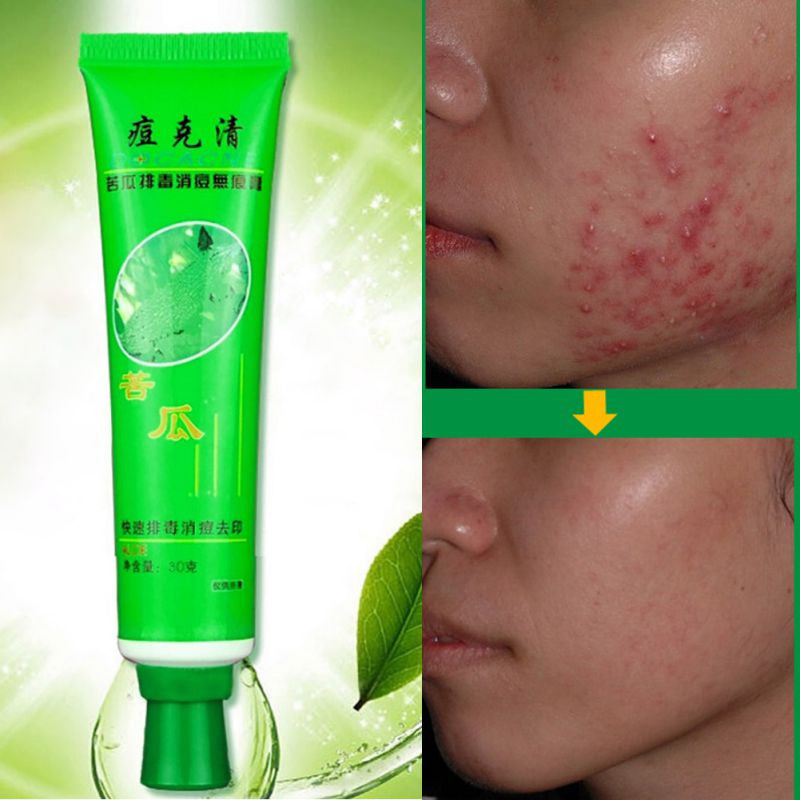 Acne Scar Removal Cream