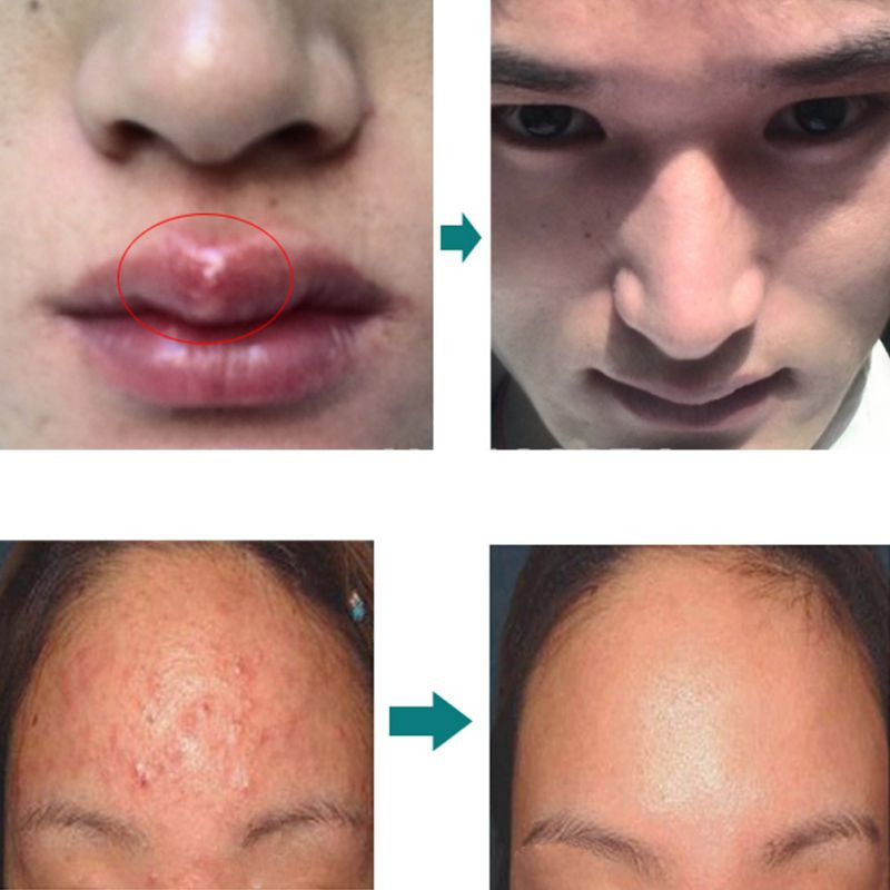 Acne Scar Removal Cream